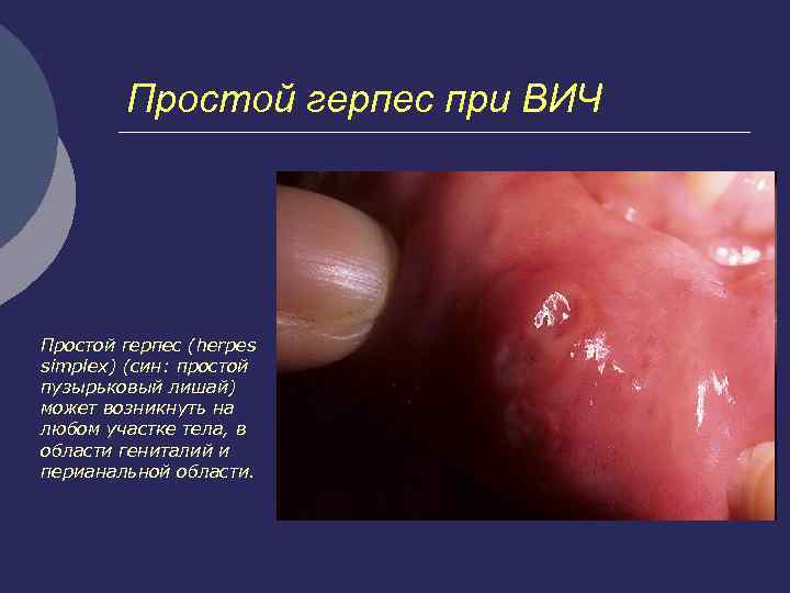 Простой герпес при ВИЧ Простой герпес (herpes simplex) (син: простой пузырьковый лишай) может возникнуть
