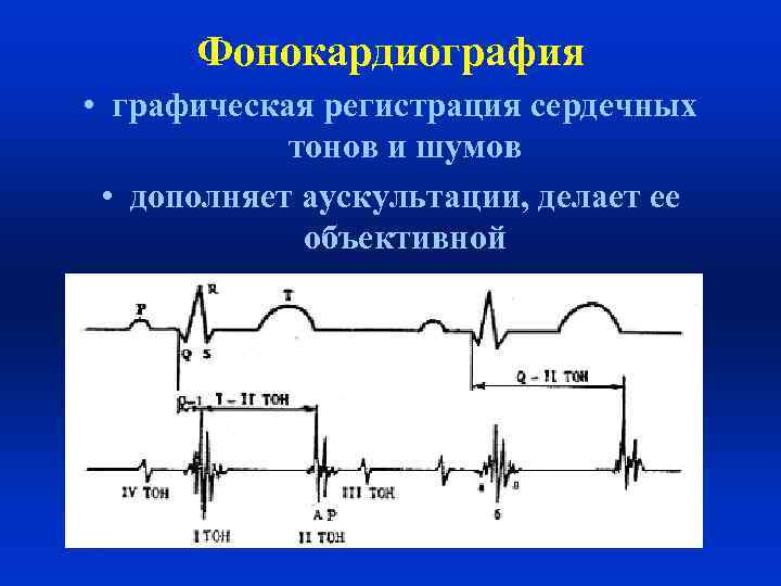 Фонокардиография • графическая регистрация сердечных тонов и шумов • дополняет аускультации, делает ее объективной