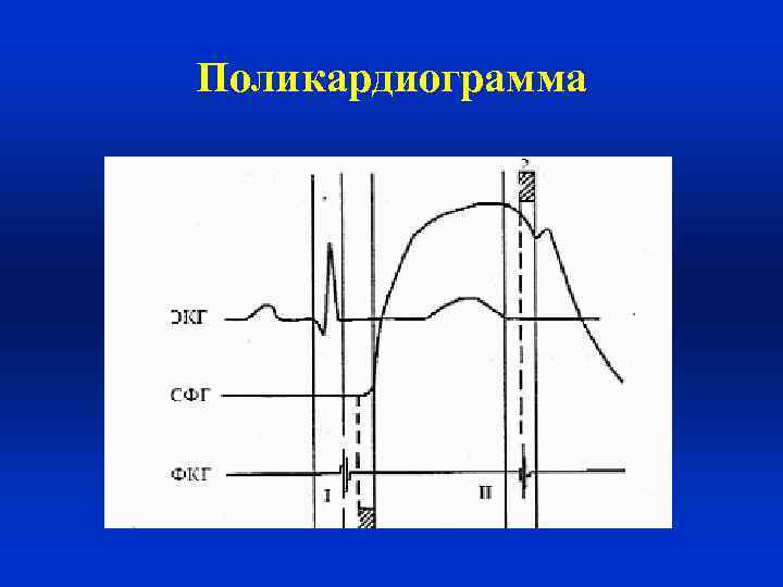 Поликардиограмма 