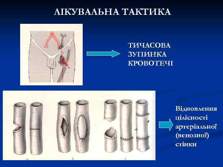 ЛІКУВАЛЬНА ТАКТИКА ТИЧАСОВА ЗУПИНКА КРОВОТЕЧІ Відновлення цілісності артеріальної (венозної) стінки 