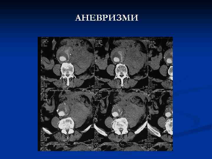 АНЕВРИЗМИ 