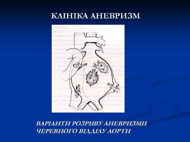 КЛІНІКА АНЕВРИЗМ ВАРІАНТИ РОЗРИВУ АНЕВРИЗМИ ЧЕРЕВНОГО ВІДДІЛУ АОРТИ 