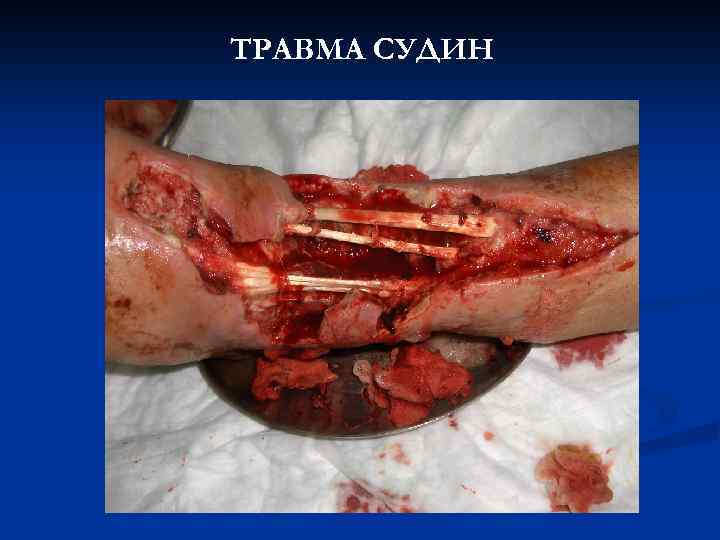 ТРАВМА СУДИН 