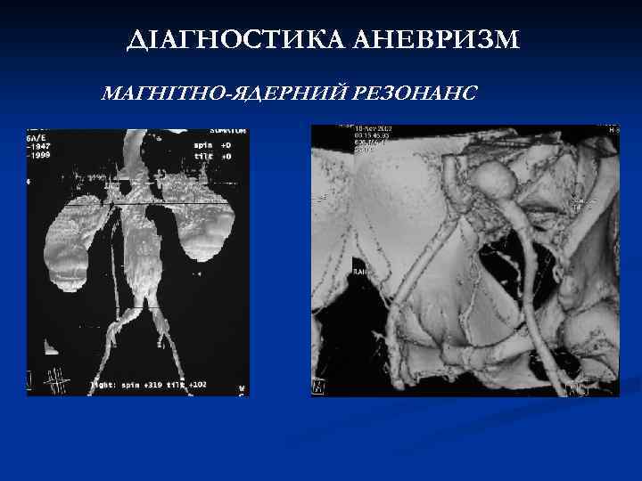 ДІАГНОСТИКА АНЕВРИЗМ МАГНІТНО-ЯДЕРНИЙ РЕЗОНАНС 