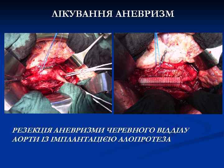 ЛІКУВАННЯ АНЕВРИЗМ РЕЗЕКЦІЯ АНЕВРИЗМИ ЧЕРЕВНОГО ВІДДІЛУ АОРТИ ІЗ ІМПЛАНТАЦІЄЮ АЛОПРОТЕЗА 