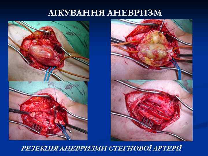 ЛІКУВАННЯ АНЕВРИЗМ РЕЗЕКЦІЯ АНЕВРИЗМИ СТЕГНОВОЇ АРТЕРІЇ 