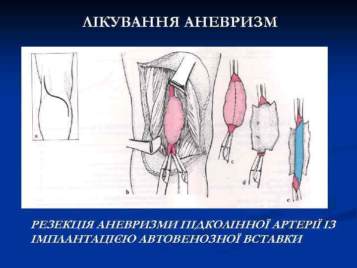 ЛІКУВАННЯ АНЕВРИЗМ РЕЗЕКЦІЯ АНЕВРИЗМИ ПІДКОЛІННОЇ АРТЕРІЇ ІЗ ІМПЛАНТАЦІЄЮ АВТОВЕНОЗНОЇ ВСТАВКИ 