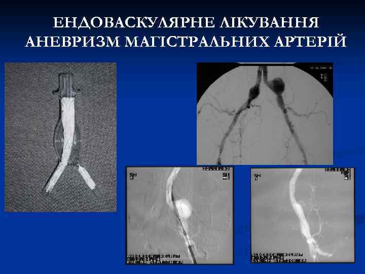 ЕНДОВАСКУЛЯРНЕ ЛІКУВАННЯ АНЕВРИЗМ МАГІСТРАЛЬНИХ АРТЕРІЙ 