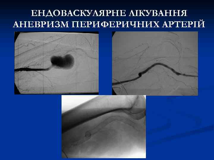 ЕНДОВАСКУЛЯРНЕ ЛІКУВАННЯ АНЕВРИЗМ ПЕРИФЕРИЧНИХ АРТЕРІЙ 