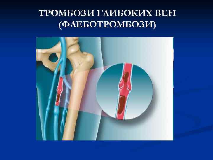 ТРОМБОЗИ ГЛИБОКИХ ВЕН (ФЛЕБОТРОМБОЗИ) 