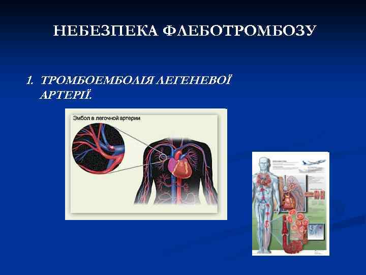 НЕБЕЗПЕКА ФЛЕБОТРОМБОЗУ 1. ТРОМБОЕМБОЛІЯ ЛЕГЕНЕВОЇ АРТЕРІЇ. 