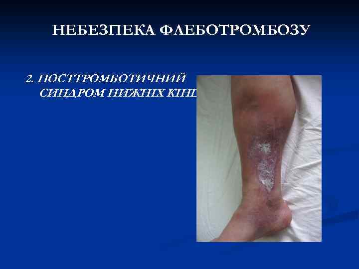 НЕБЕЗПЕКА ФЛЕБОТРОМБОЗУ 2. ПОСТТРОМБОТИЧНИЙ СИНДРОМ НИЖНІХ КІНЦІВОК. 