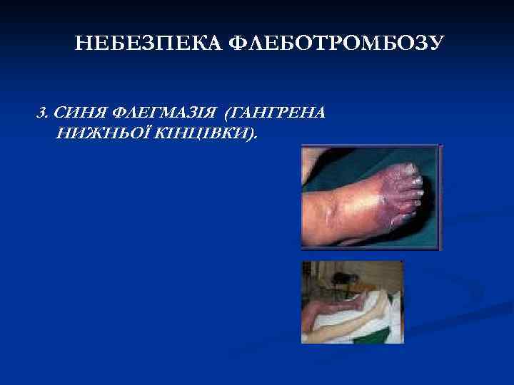 НЕБЕЗПЕКА ФЛЕБОТРОМБОЗУ 3. СИНЯ ФЛЕГМАЗІЯ (ГАНГРЕНА НИЖНЬОЇ КІНЦІВКИ). 