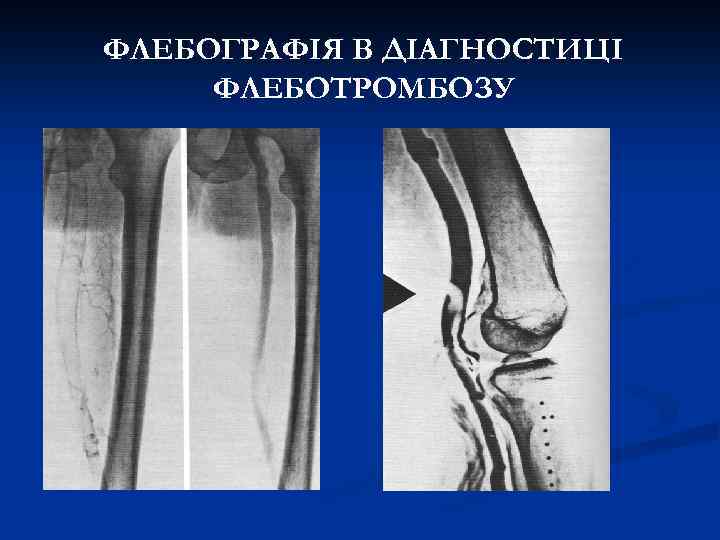 ФЛЕБОГРАФІЯ В ДІАГНОСТИЦІ ФЛЕБОТРОМБОЗУ 