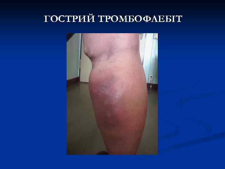 ГОСТРИЙ ТРОМБОФЛЕБІТ 