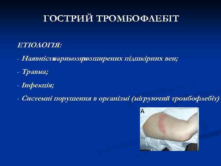 ГОСТРИЙ ТРОМБОФЛЕБІТ ЕТІОЛОГІЯ: - Наявність варикозно розширених підшкірних вен; - Травма; - Інфекція; -