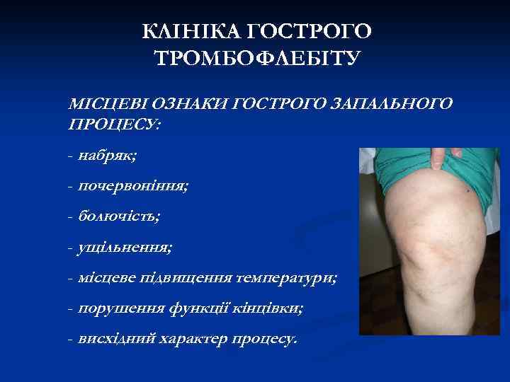 КЛІНІКА ГОСТРОГО ТРОМБОФЛЕБІТУ МІСЦЕВІ ОЗНАКИ ГОСТРОГО ЗАПАЛЬНОГО ПРОЦЕСУ: - набряк; - почервоніння; - болючість;
