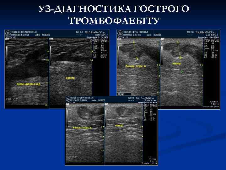 УЗ-ДІАГНОСТИКА ГОСТРОГО ТРОМБОФЛЕБІТУ 