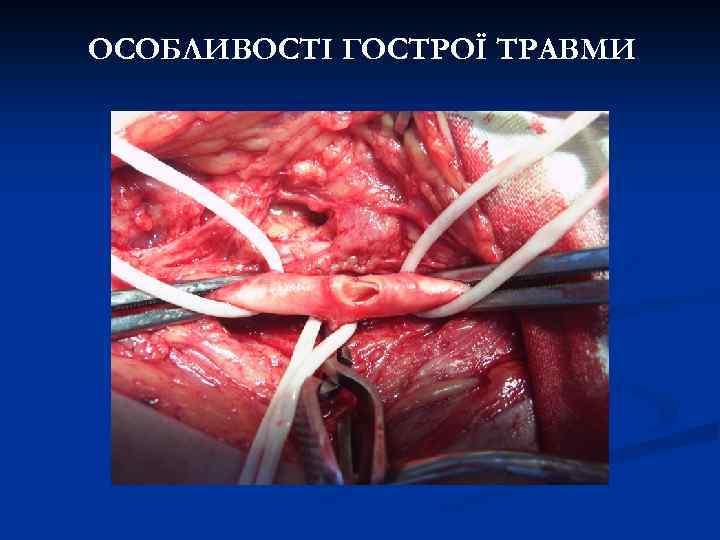 ОСОБЛИВОСТІ ГОСТРОЇ ТРАВМИ 