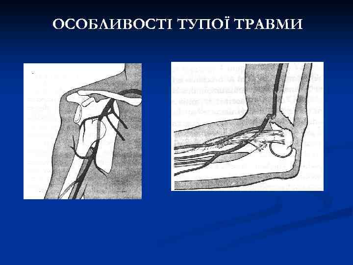 ОСОБЛИВОСТІ ТУПОЇ ТРАВМИ 