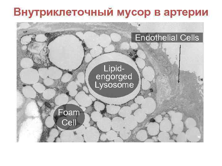 Внутриклеточный мусор в артерии Endothelial Cells Lipidengorged Lysosome Foam Cell 