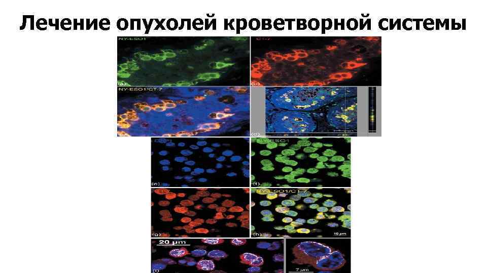 Лечение опухолей кроветворной системы 