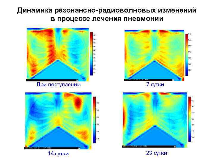 Динамика резонансно-радиоволновых изменений в процессе лечения пневмонии При поступлении 7 сутки 14 сутки 23