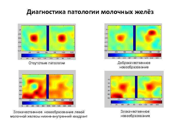 Диагностика патологии молочных желёз Отсутствие патологии Злокачественное новообразование левой молочной железы нижне-внутренний квадрант Доброкачественное