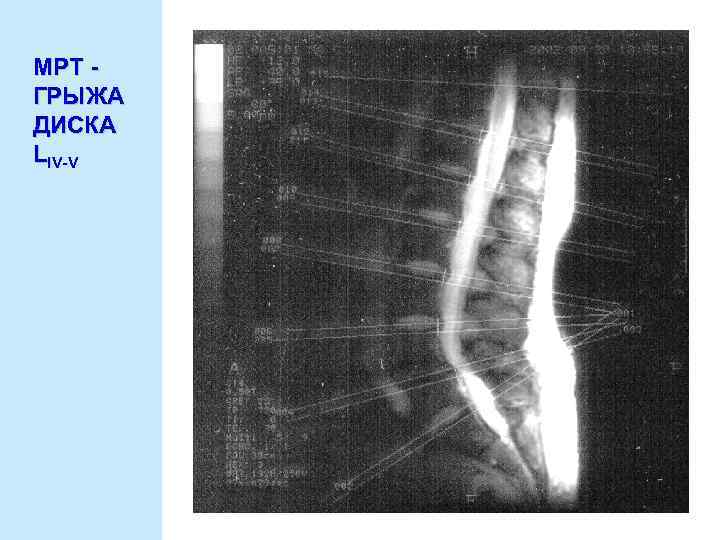 МРТ ГРЫЖА ДИСКА LIV-V 