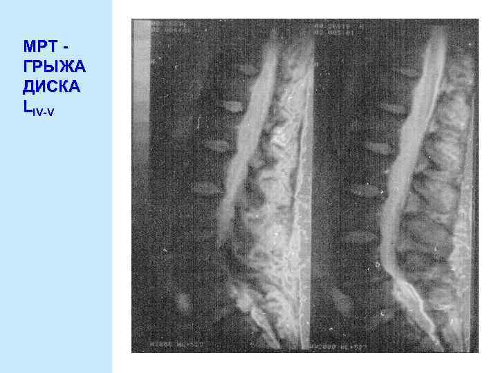 МРТ ГРЫЖА ДИСКА LIV-V 