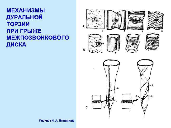 МЕХАНИЗМЫ ДУРАЛЬНОЙ ТОРЗИИ ПРИ ГРЫЖЕ МЕЖПОЗВОНКОВОГО ДИСКА Рисунок И. А. Литвинова 