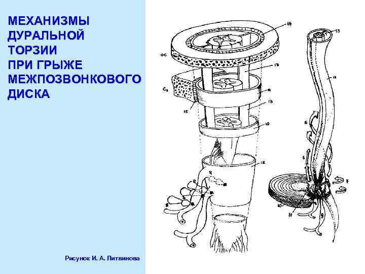 МЕХАНИЗМЫ ДУРАЛЬНОЙ ТОРЗИИ ПРИ ГРЫЖЕ МЕЖПОЗВОНКОВОГО ДИСКА Рисунок И. А. Литвинова 