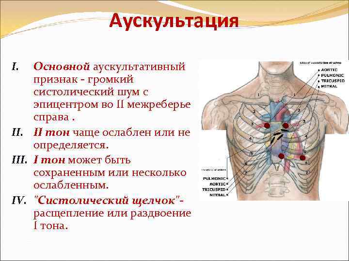 Склеродегенеративный порок аортального клапана