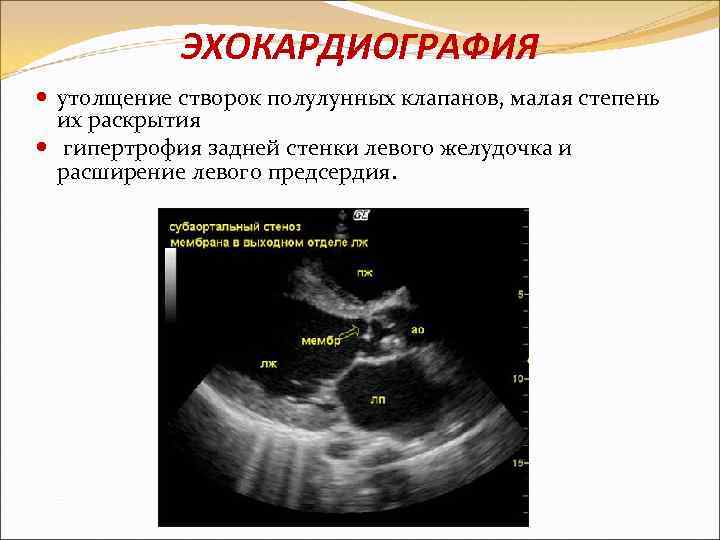 Утолщение створок аортального клапана