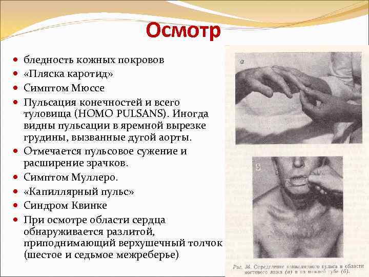 Осмотр бледность кожных покровов «Пляска каротид» Симптом Мюссе Пульсация конечностей и всего туловища (HOMO