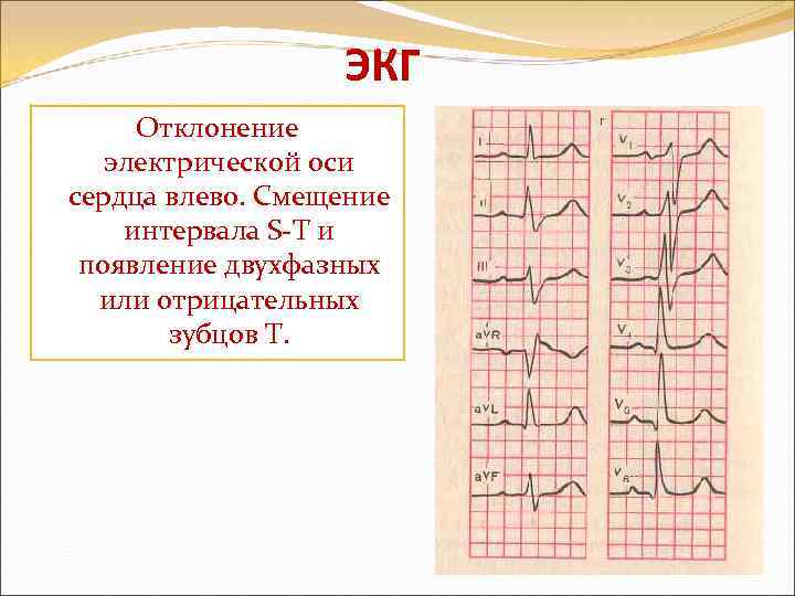 Экг резкое отклонение влево