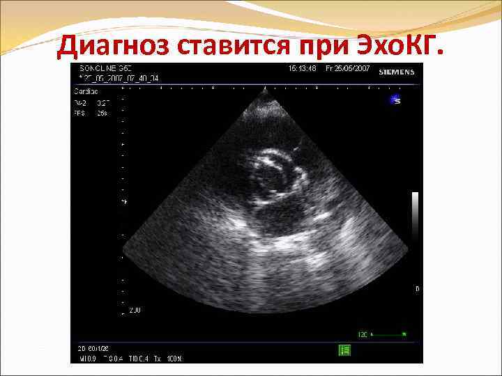 Диагноз ставится при Эхо. КГ. 