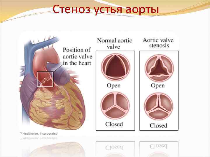 Фиброз стенок аортального клапана