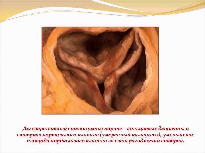 Дегенеративный стеноз устья аорты – кальциевые депозиты в створках аортального клапана (умеренный кальциноз), уменьшение