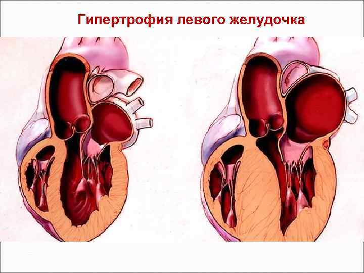 Фиброз стенок аортального клапана