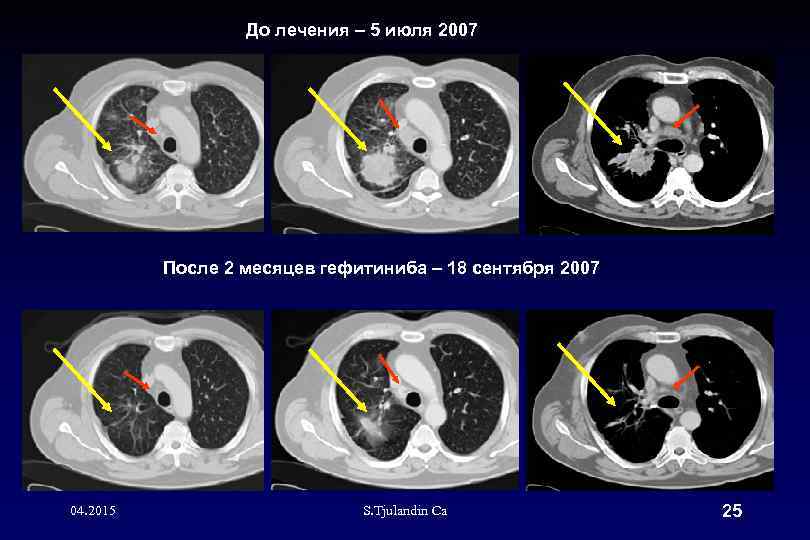 До лечения – 5 июля 2007 После 2 месяцев гефитиниба – 18 сентября 2007