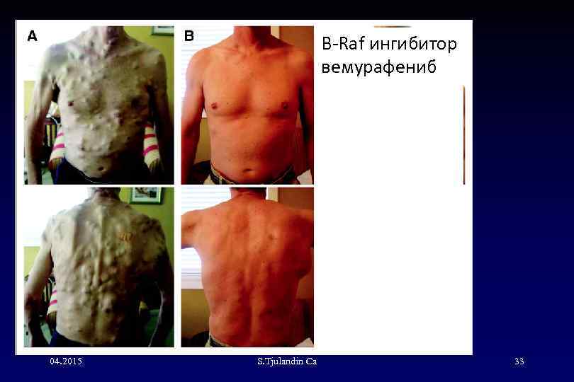 B-Raf ингибитор вемурафениб 04. 2015 S. Tjulandin Са 33 