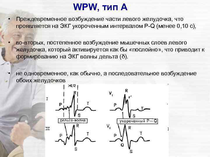 Синдром типа б. ЭКГ при ВПВ синдроме Тип в. Синдром wpw Тип а на ЭКГ. ЭКГ критерии синдрома wpw. Wpw синдром ЭКГ.