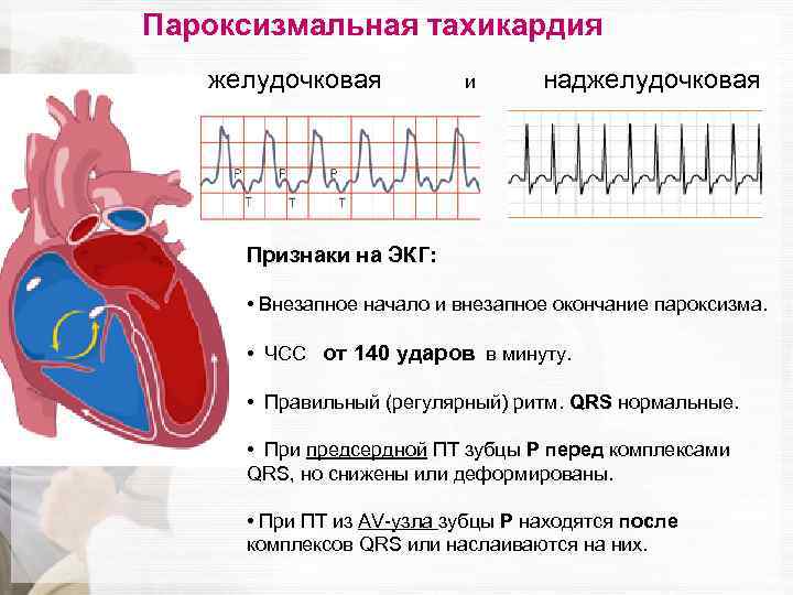 Пароксизмальная тахикардия желудочковая и наджелудочковая Признаки на ЭКГ: • Внезапное начало и внезапное окончание