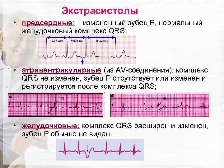 Экстрасистолы • предсердные: измененный зубец P, нормальный желудочковый комплекс QRS; • атривентрикулярные (из AV-соединения):