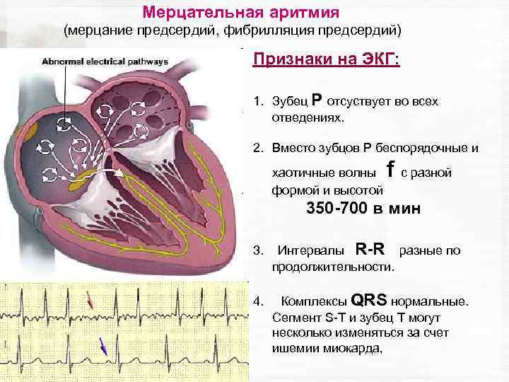 Мерцательная аритмия (мерцание предсердий, фибрилляция предсердий) Признаки на ЭКГ: 1. Зубец P отсуствует во