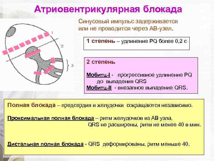 Атриовентрикулярная блокада Синусовый импульс задерживается или не проводится через АВ-узел. 1 степень – удлинение