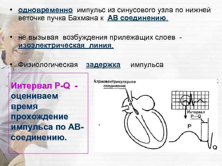  • одновременно импульс из синусового узла по нижней веточке пучка Бахмана к АВ