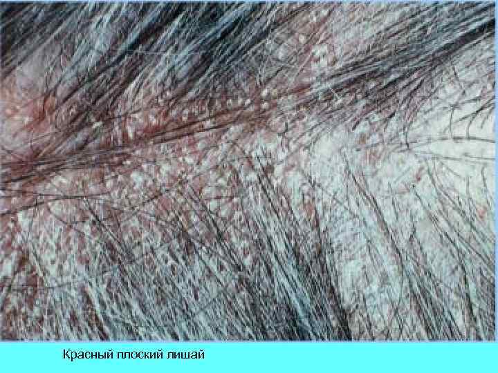 Красный плоский лишай 