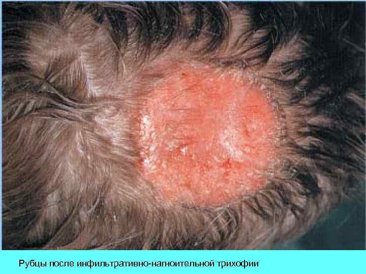 Рубцы после инфильтративно-нагноительной трихофии 